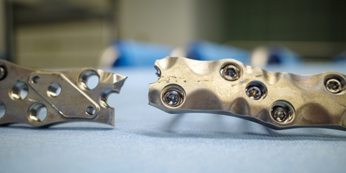 a broken titanium plate was removed from a patient