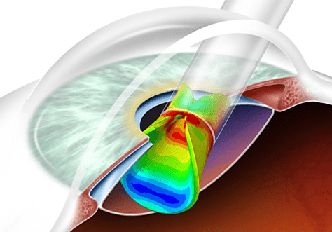 Computational modeling of the intraocular lens.